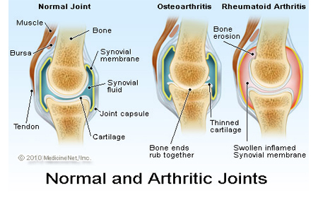 What are the other types of Arthritis?